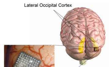 Logran que una persona ciega recupere parte de la visión con microestimulación cerebral